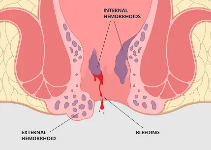 Medical illustration showing internal and external hemorrhoids in the rectal area, with labels pointing to internal hemorrhoids, external hemorrhoids, and bleeding from the anus.
